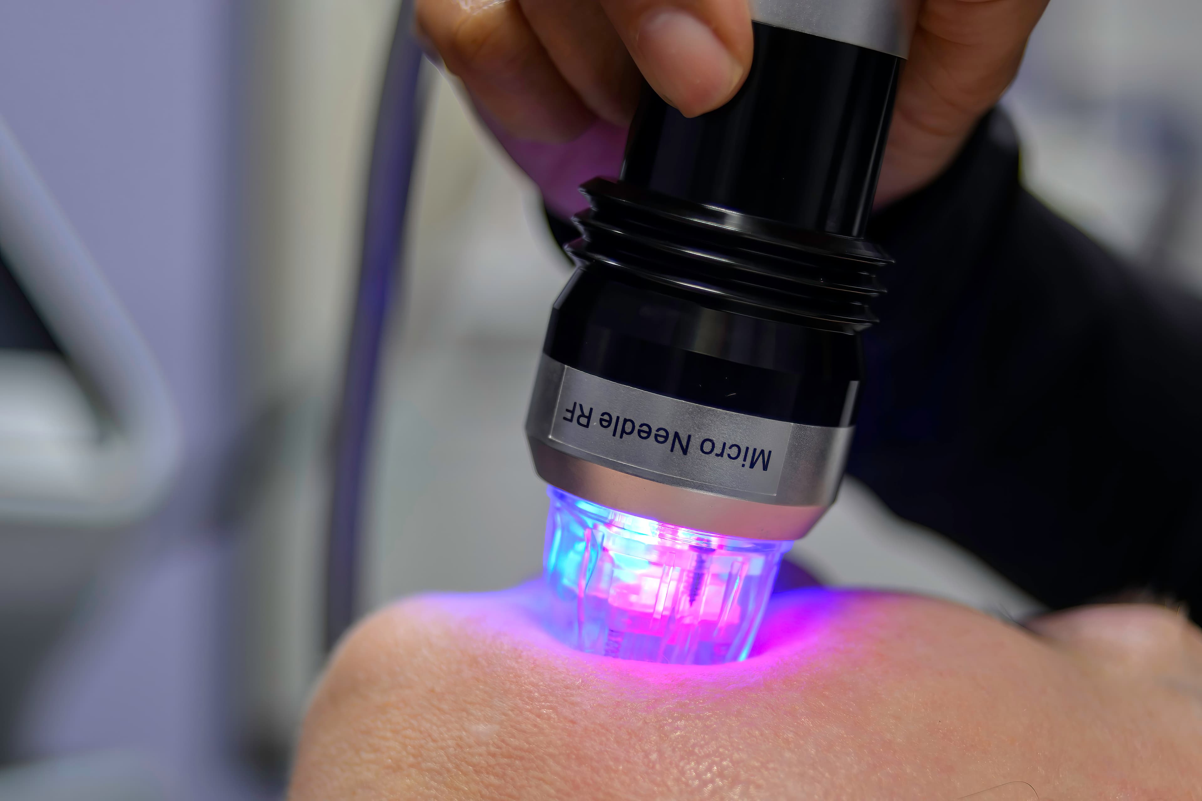 Scarlet RF Microneedling skin tightening at MC Aesthetics McMinnville