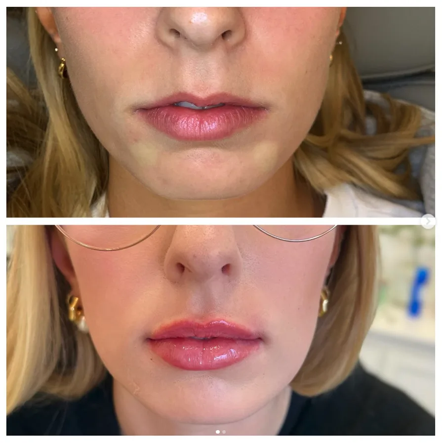 Natural lip filler results at MC Aesthetics in McMinnville, OR